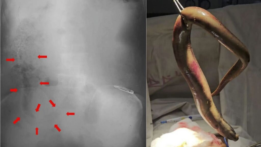 Diagnostic dilemma: Fisher’s colon punctured by eel that snuck in through his rectum Diagnostic dilemma: Fisher’s colon punctured by eel that snuck in through his rectum